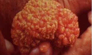 男性湿锐尖初期图片 男性湿锐尖初期图片