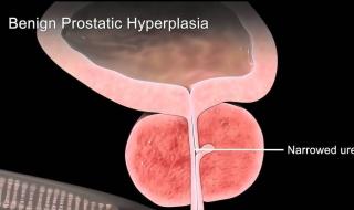 晚上尿多怎么回事 晚上尿多怎么回事